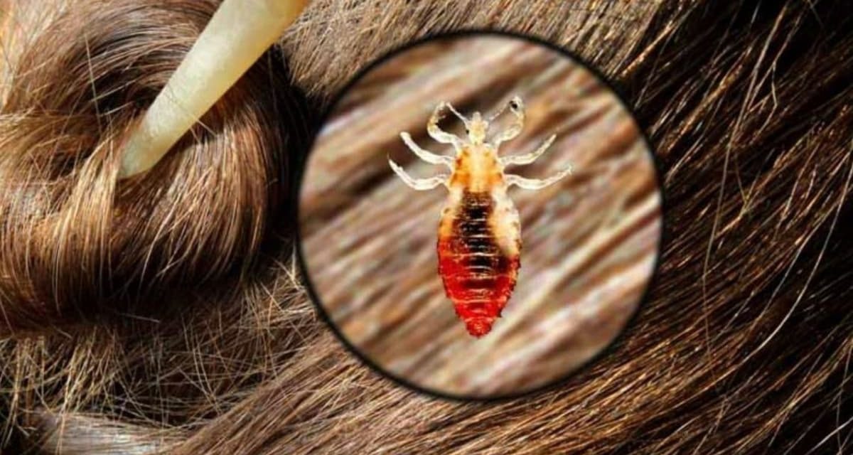 Emite IMSS recomendaciones para prevenir infestación de piojos  
