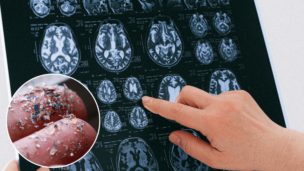 Estudio revela alta concentración de microplásticos en el cerebro humano