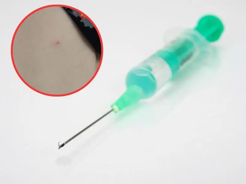 ‘Needle spiking’ o pinchazos con agujas: cómo operan estas agresiones químicas con agujas