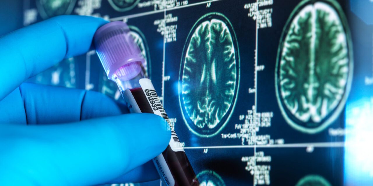 Autorizan primera prueba de sangre para diagnóstico de Alzheimer