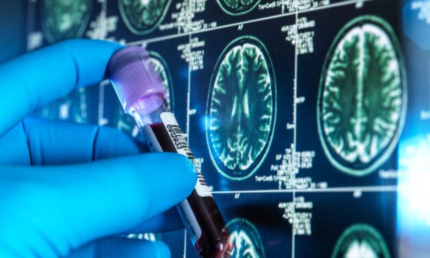 Autorizan primera prueba de sangre para diagnóstico de Alzheimer