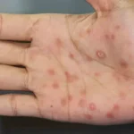 Se disparan los casos de sífilis; Chihuahua cuenta con 777 contagios