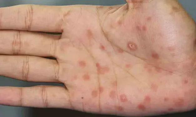 Se disparan los casos de sífilis; Chihuahua cuenta con 777 contagios