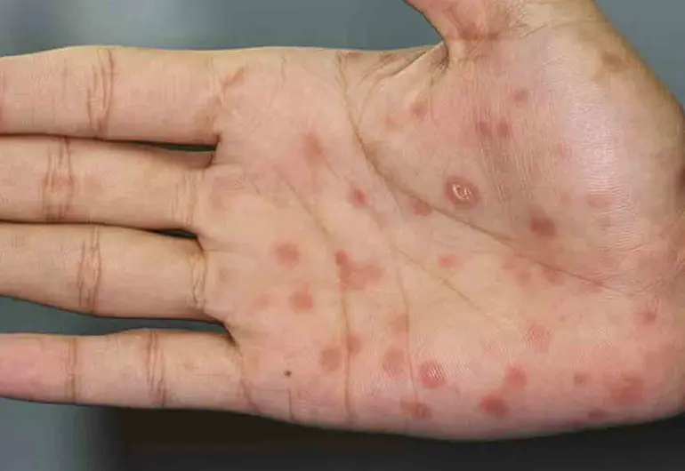 Se disparan los casos de sífilis; Chihuahua cuenta con 777 contagios