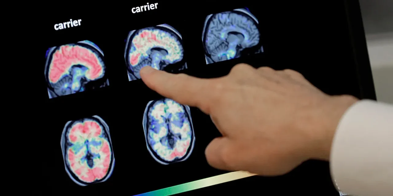 El curioso vínculo entre el cáncer y el Alzheimer: el sistema inmunitario, clave