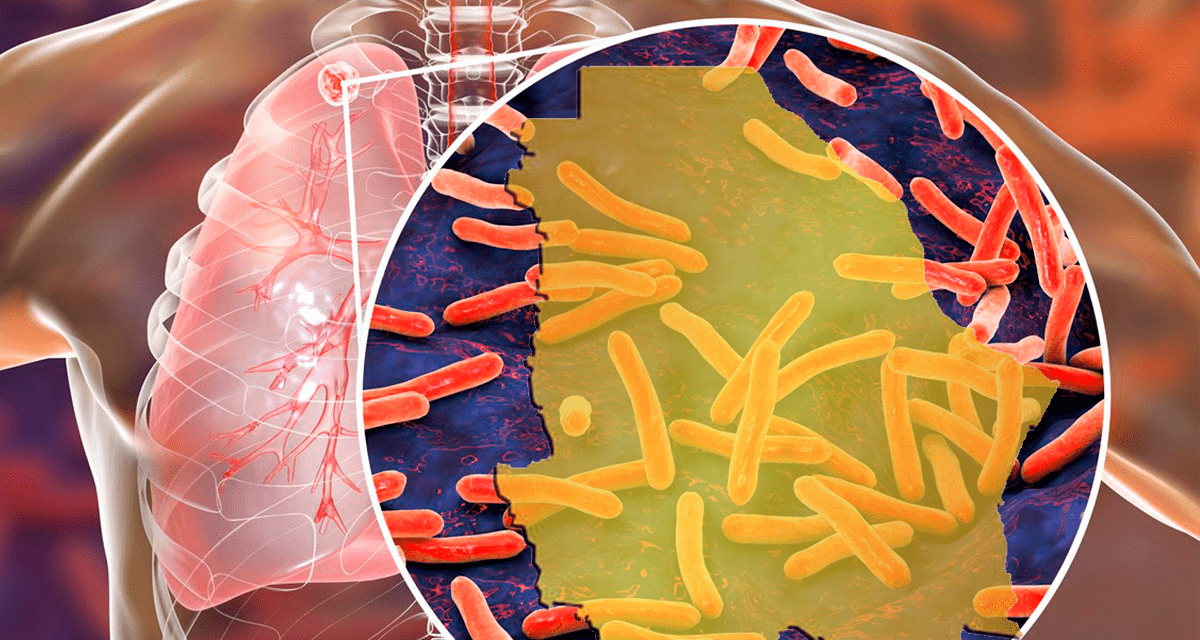 Arranca Chihuahua con 121 contagios de tuberculosis en 2026