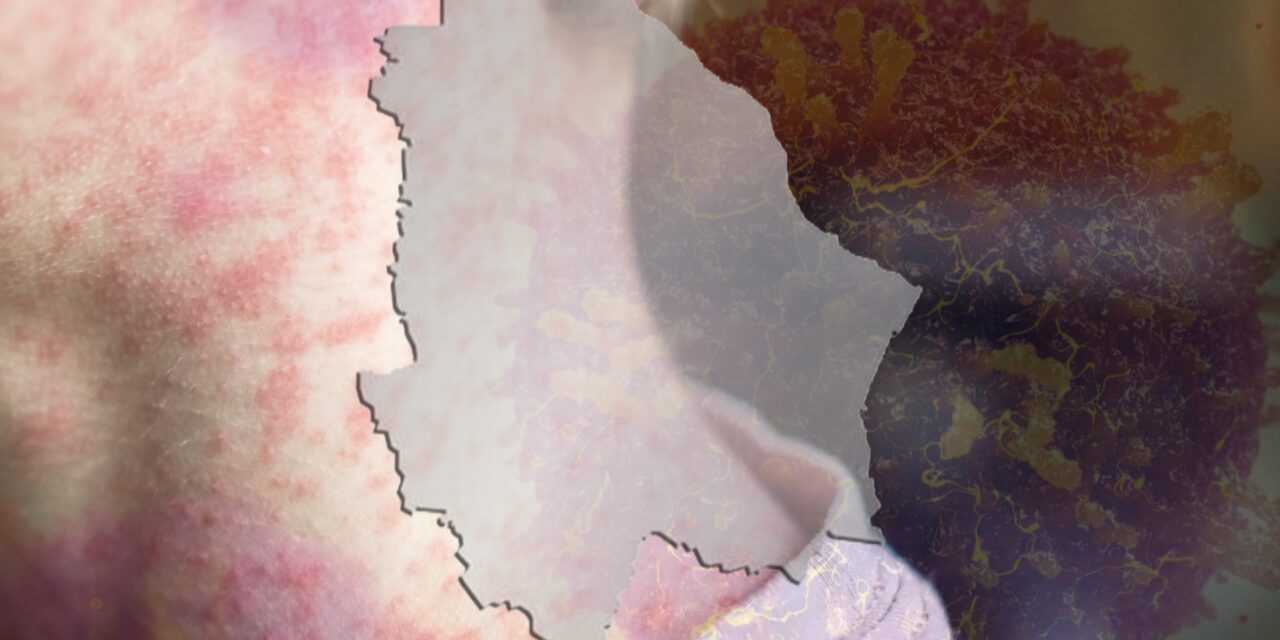 Sarampión deja 21 defunciones en el Estado de Chihuahua